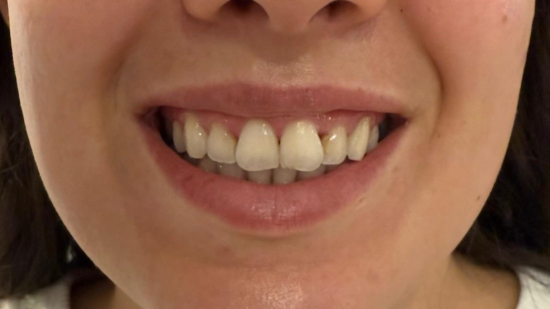 Lip Definition — after
