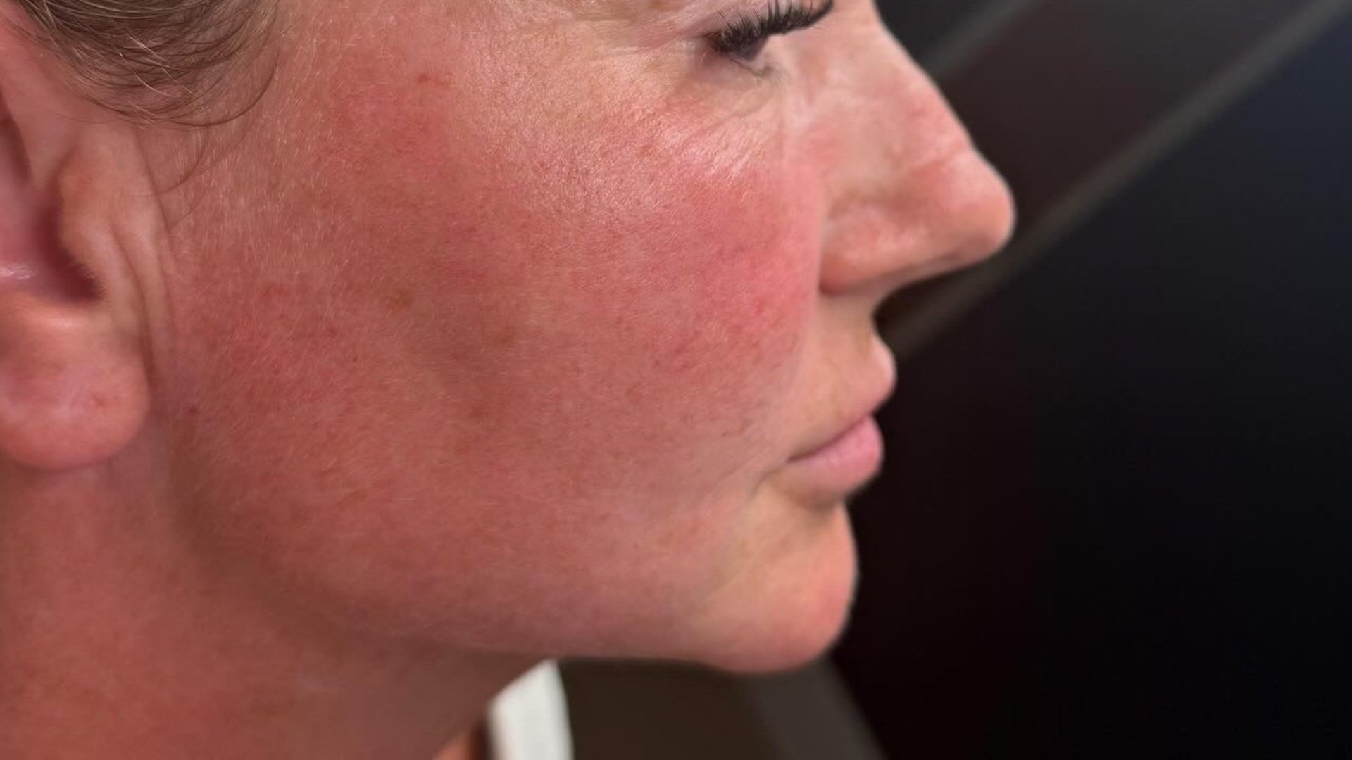 Chin Filler — after