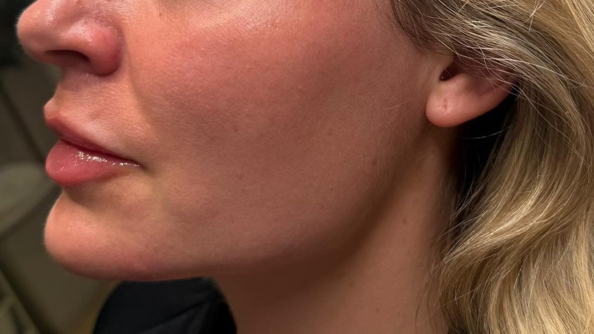 Chin Filler — after