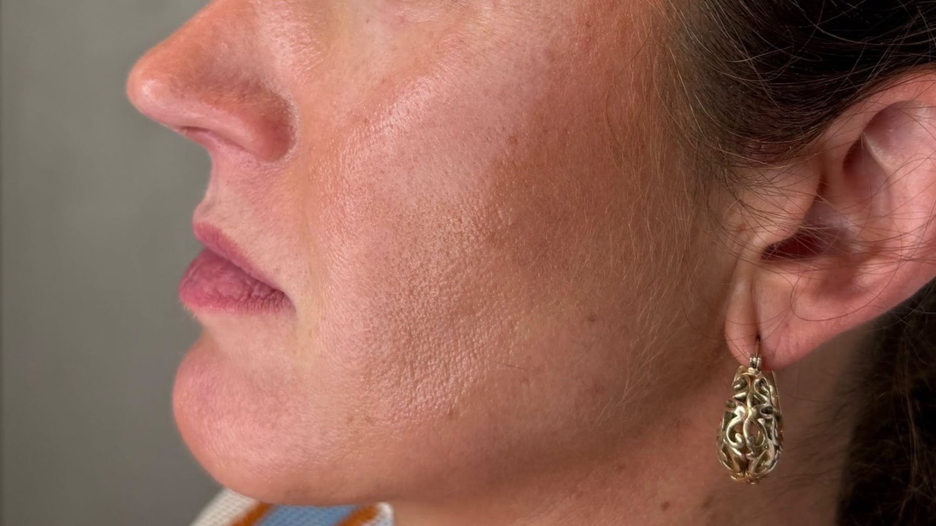 Lip filler — before