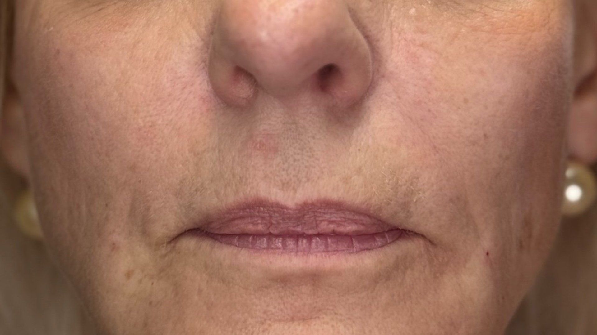 Nasolabial fold filler — after