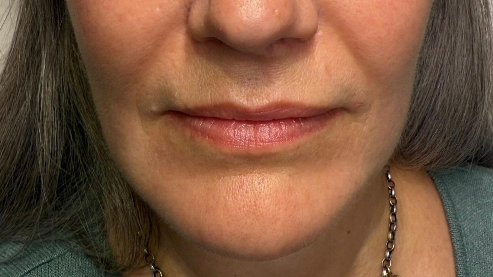 Jawline Contour — after