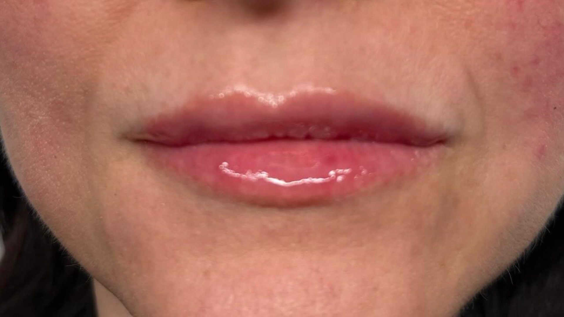Lip Enhancement — after