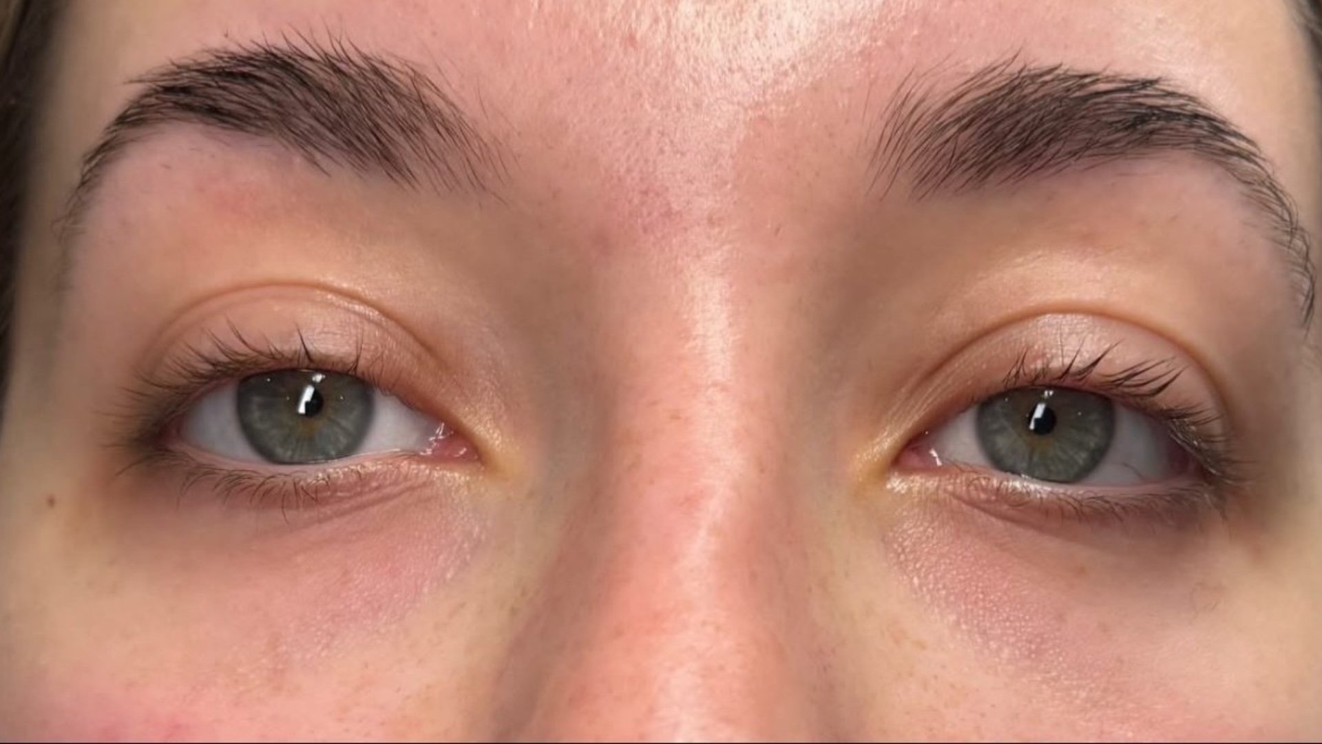 Brow and eye area — after