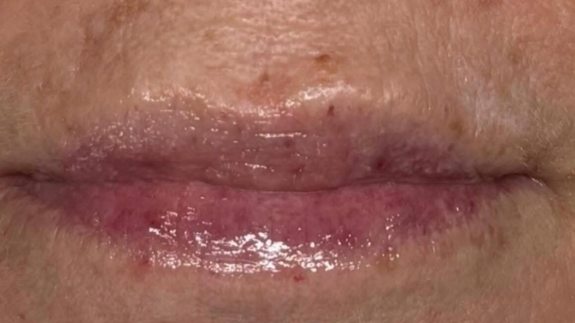 Lip filler — after