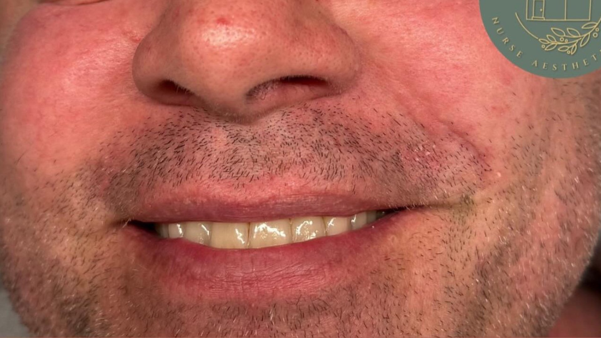 Cheek Filler — after