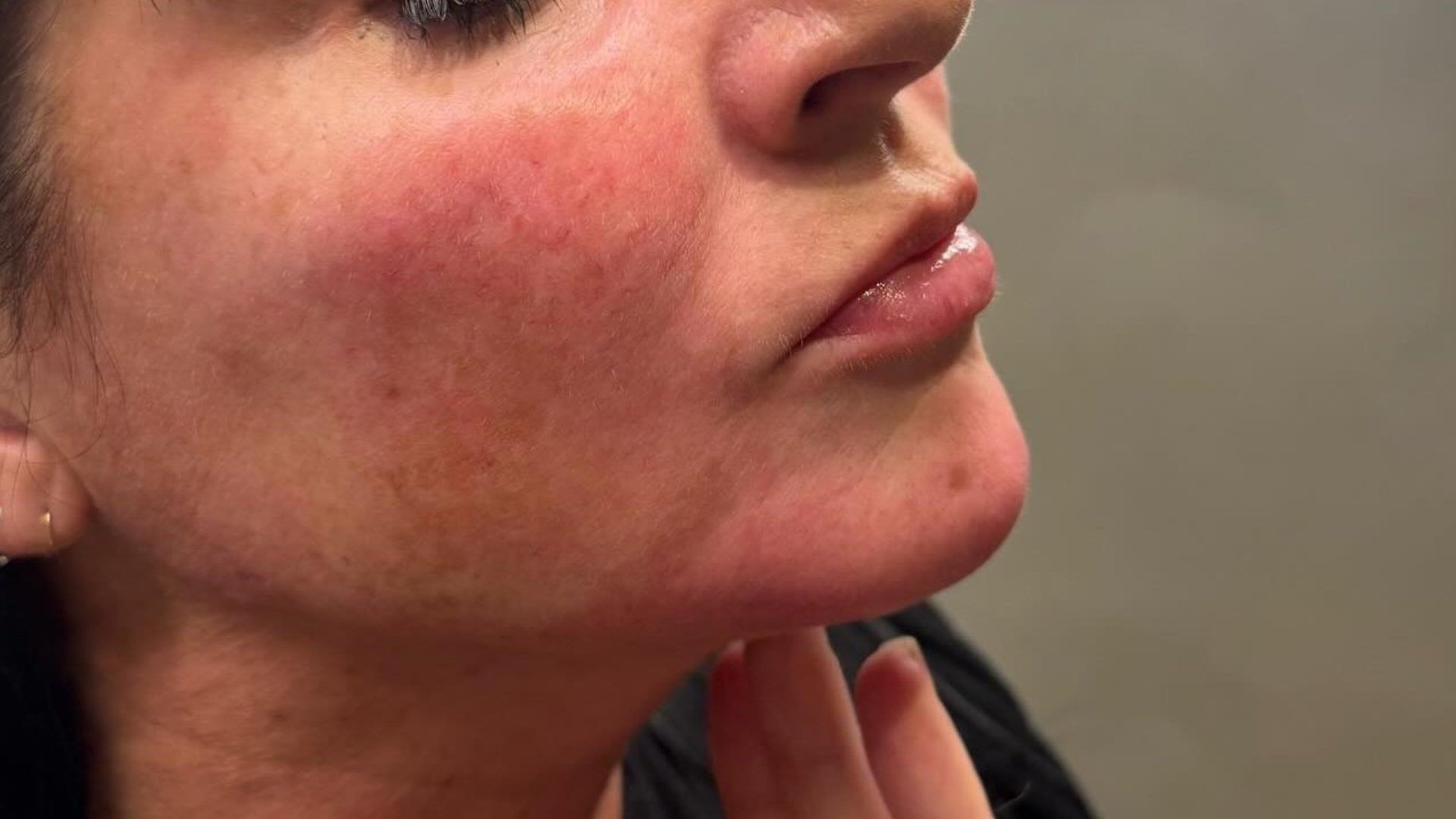 Jawline &amp; Skin — after