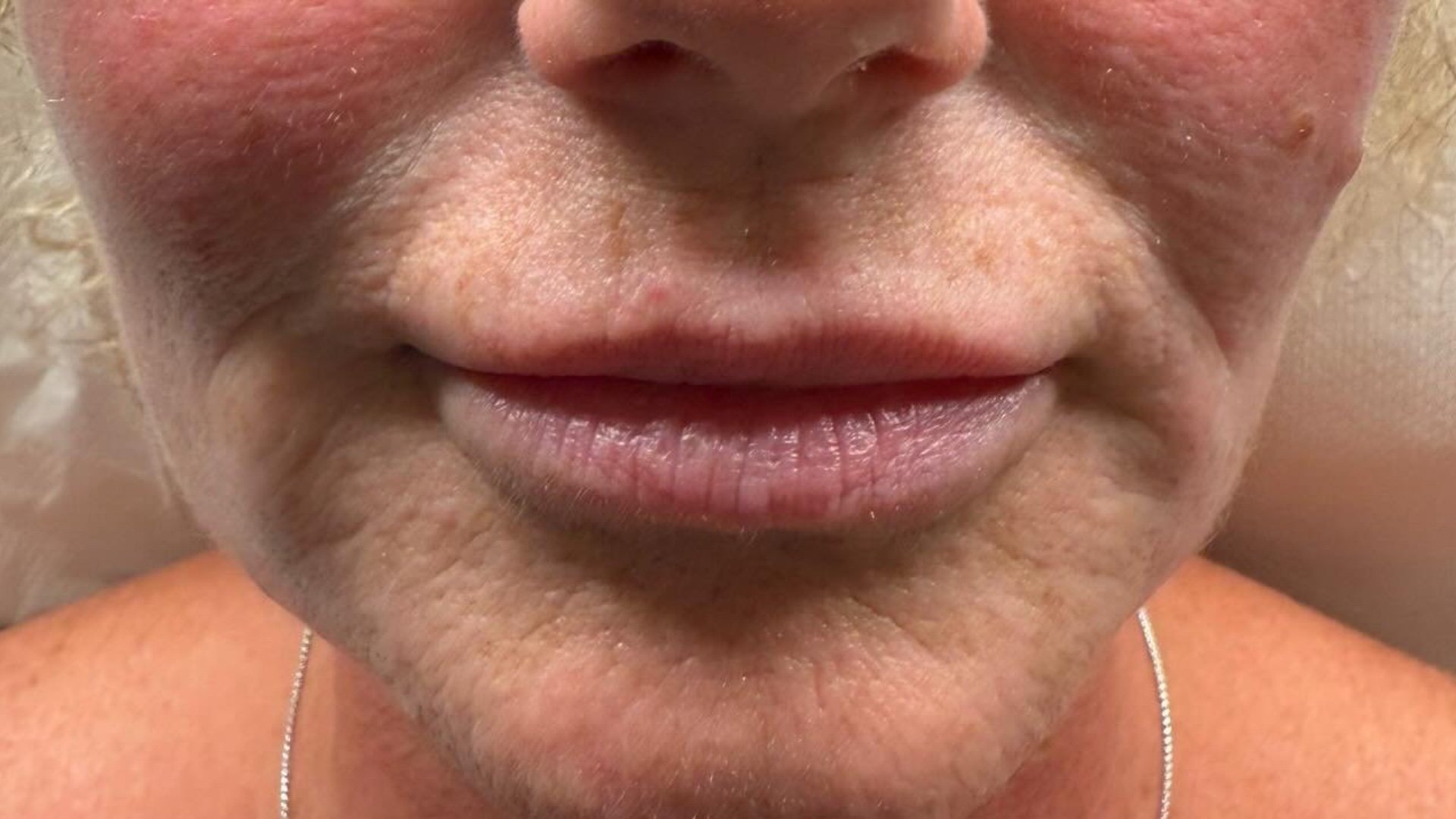Jawline &amp; Skin — before