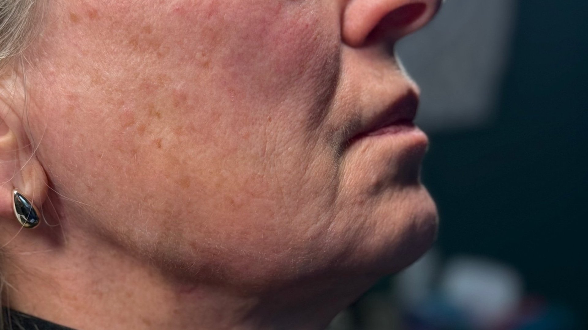 Jawline definition — before