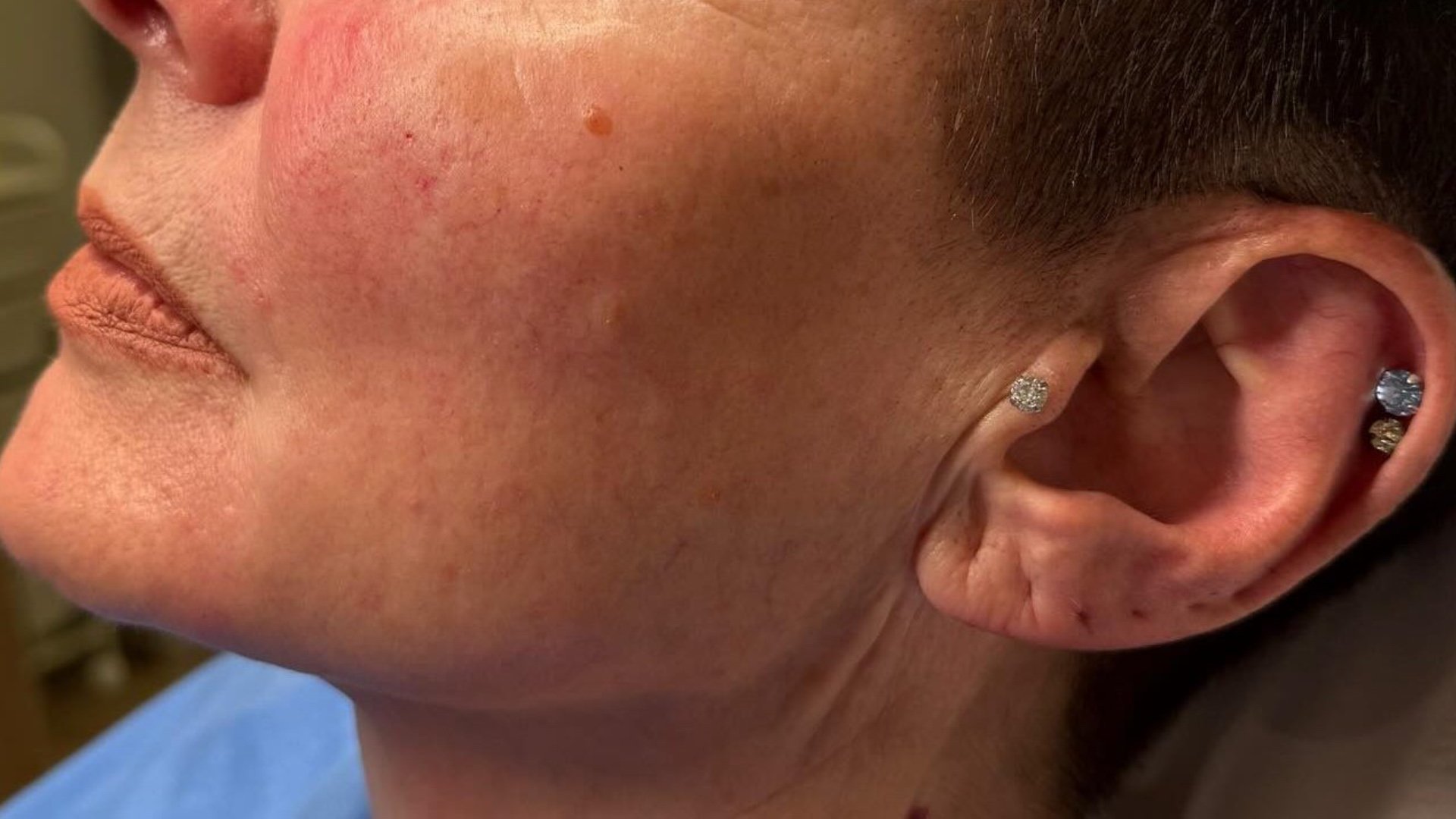Chin Filler — after