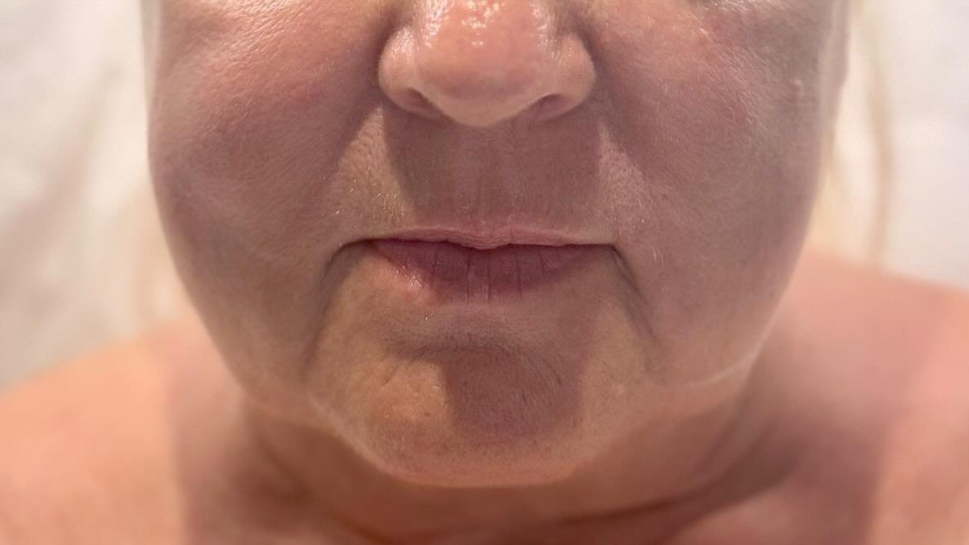 Jawline &amp; Skin — before