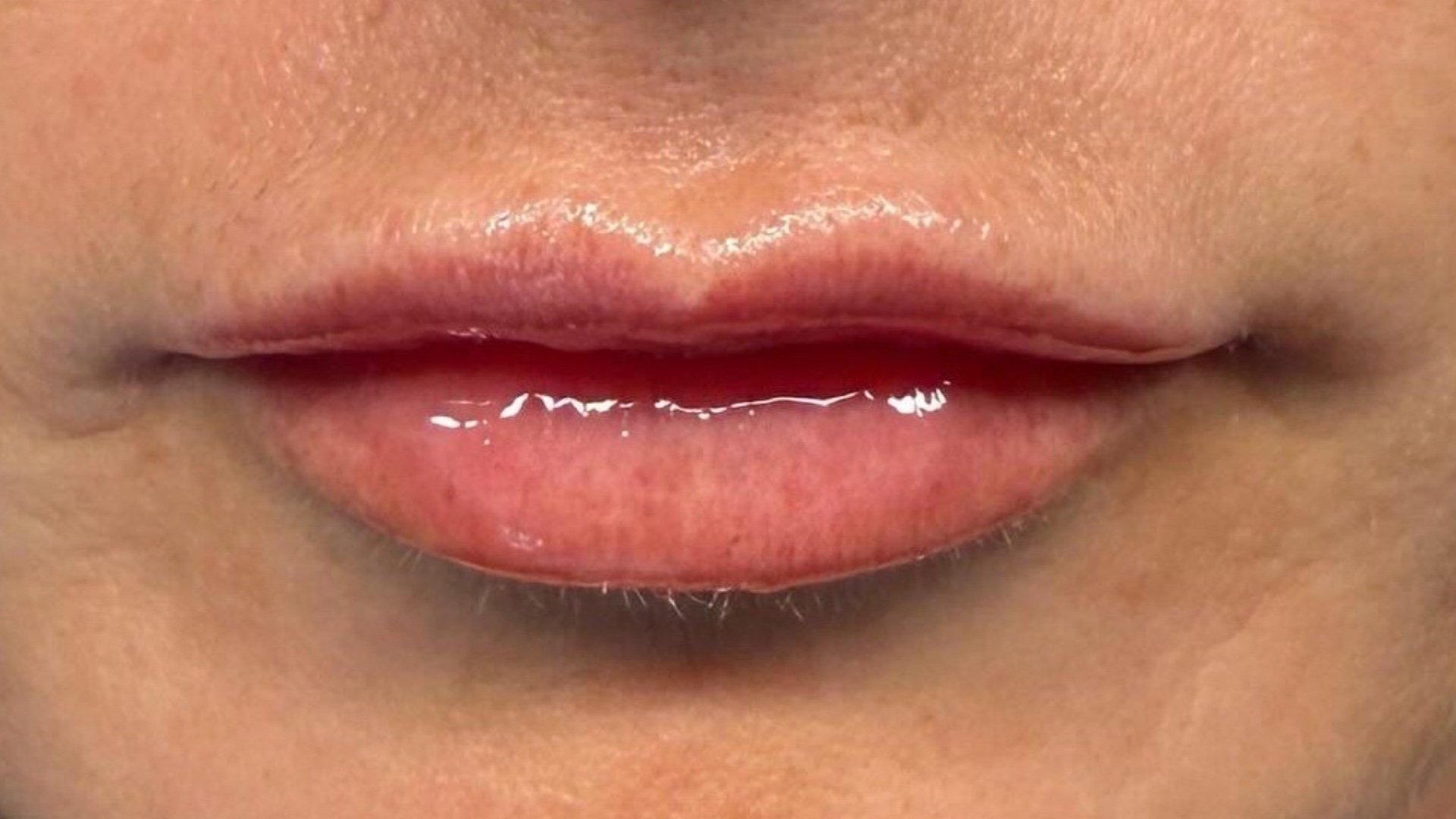 Lip Filler — after