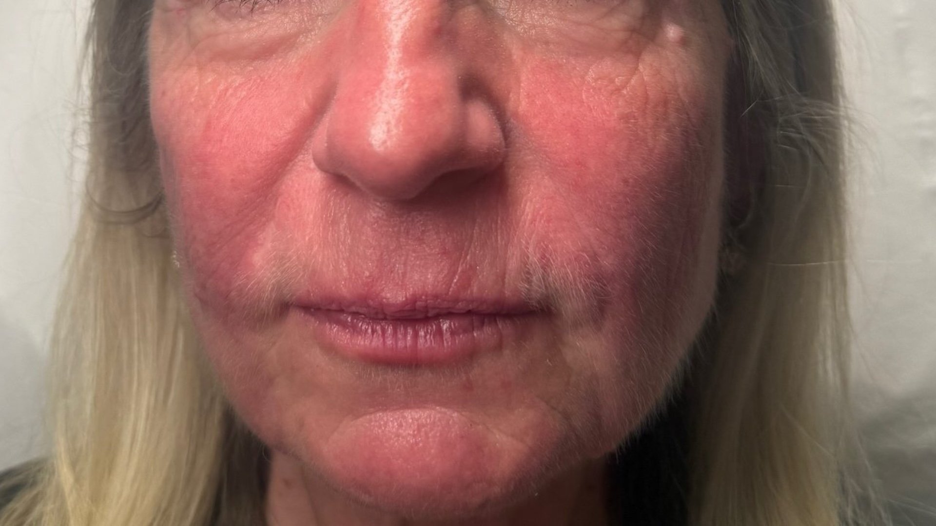 Lip Definition — after