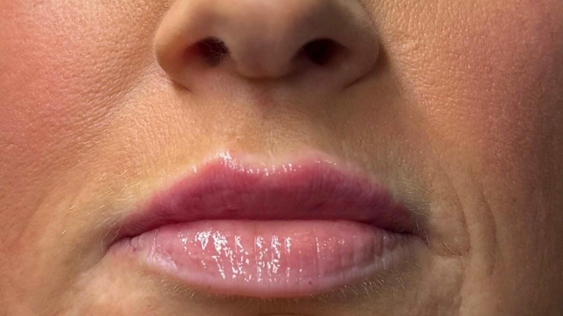 Lip Definition — after