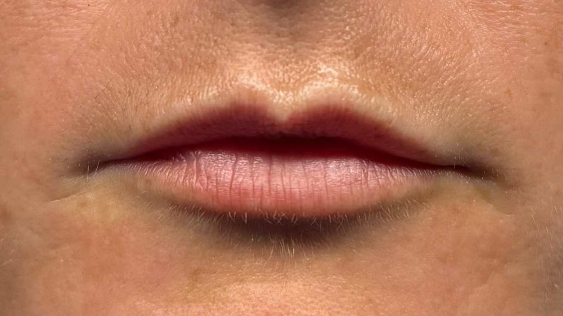 Lip Filler — before