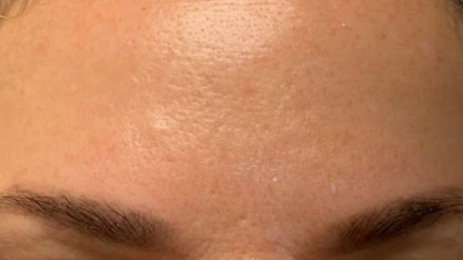 Under-Eye Rejuvenation — after