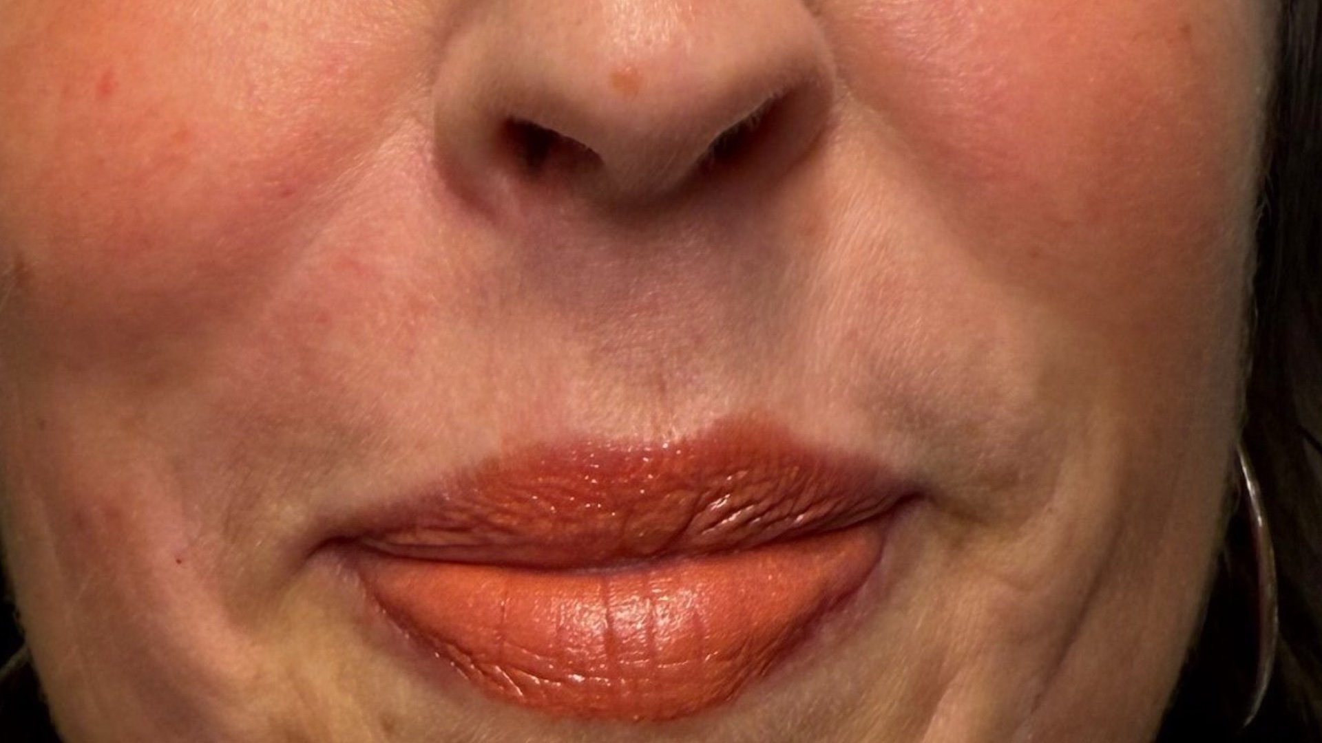 Cheek Filler — after