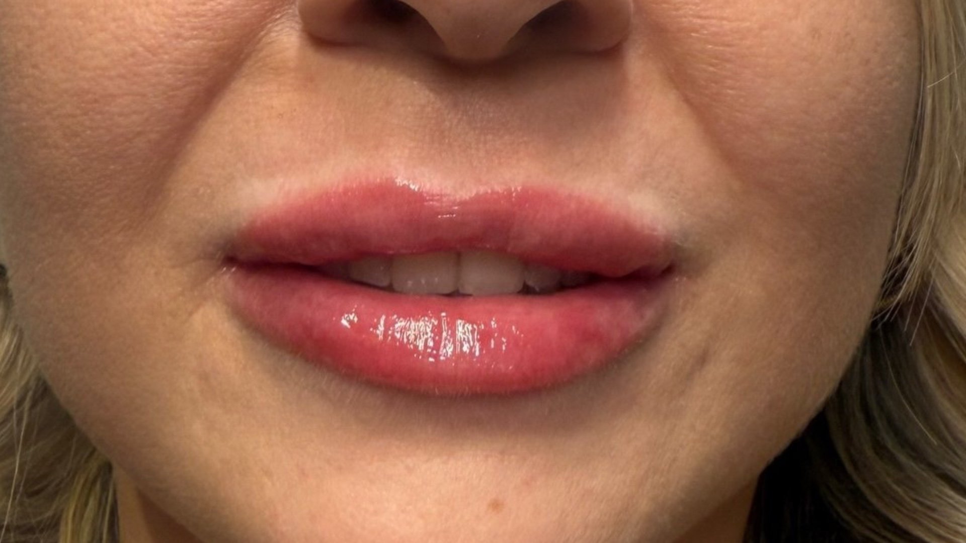 Lip Filler — after