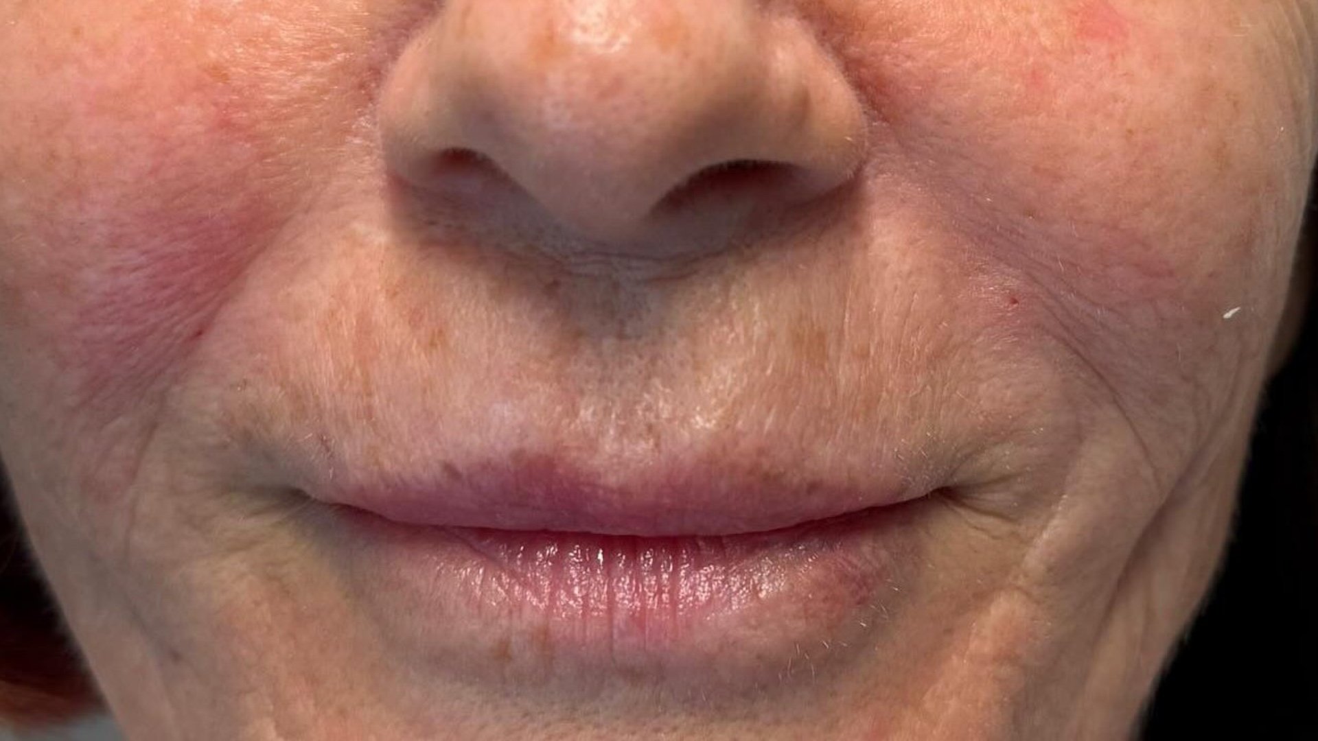 Nasolabial Folds — after