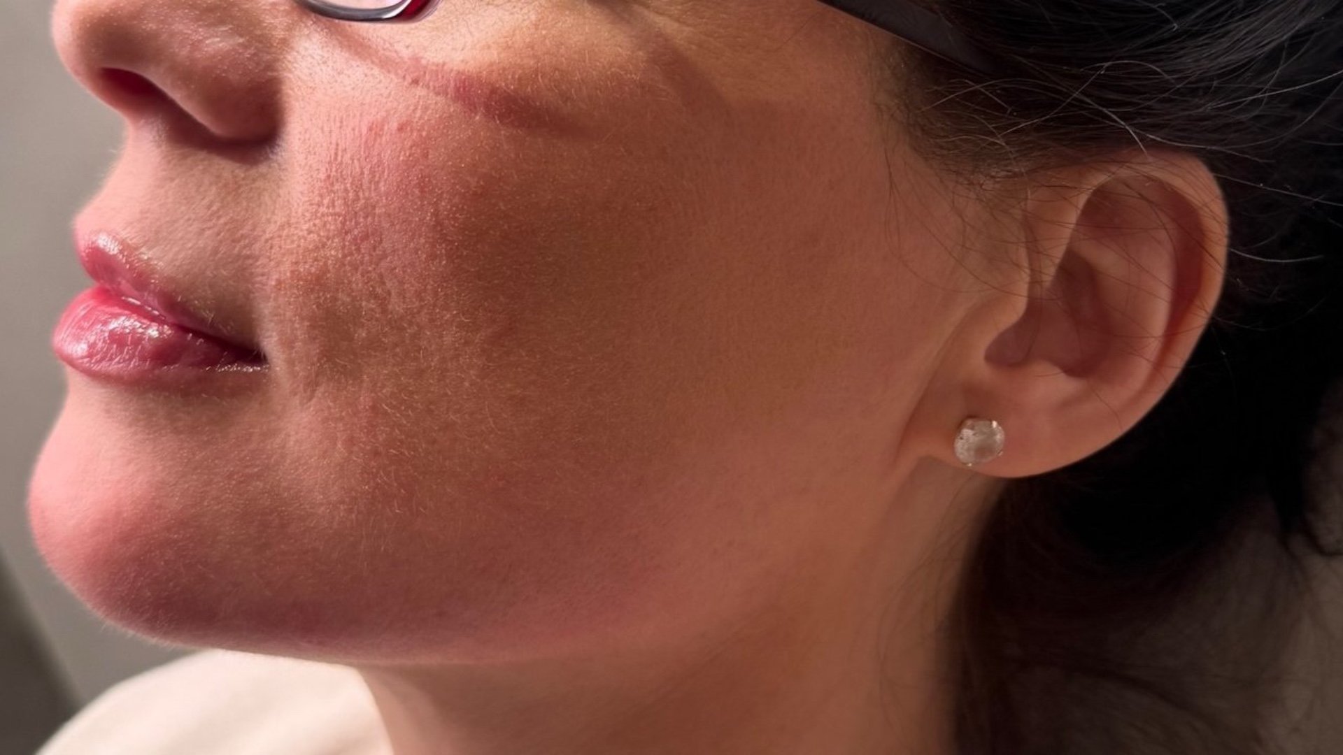 Jawline Definition — after
