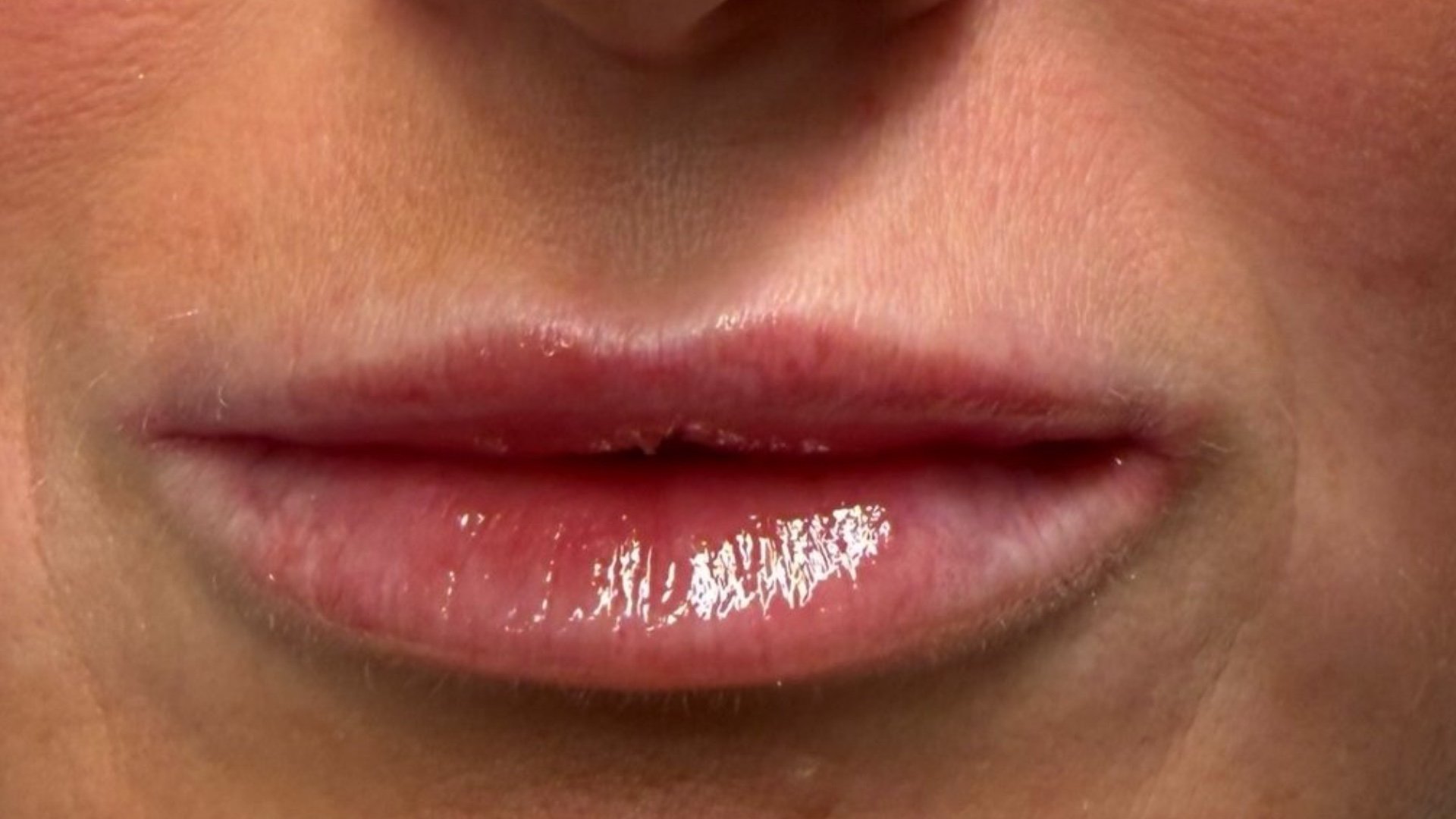 Lip Filler — after