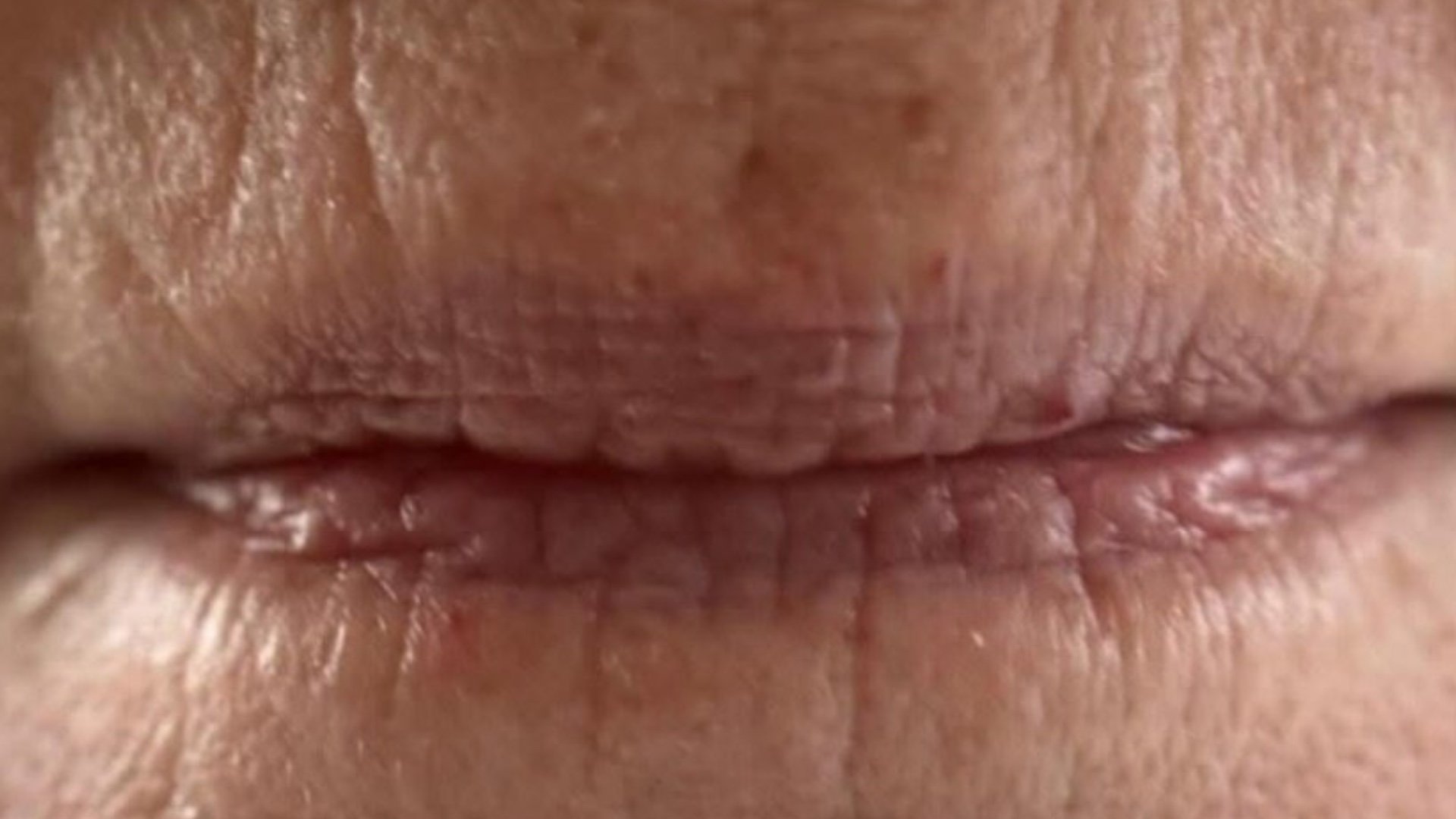 Lip filler — before