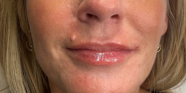 Cheek & Lip Definition — after