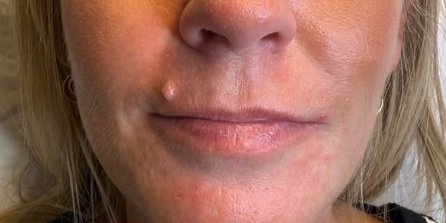 Cheek & Lip Definition — before
