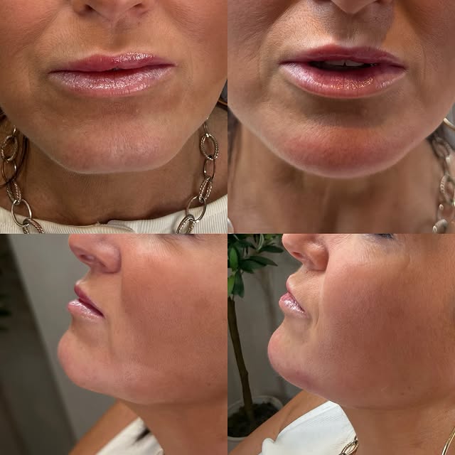 Chin and jaw filler before and after, multiple angles