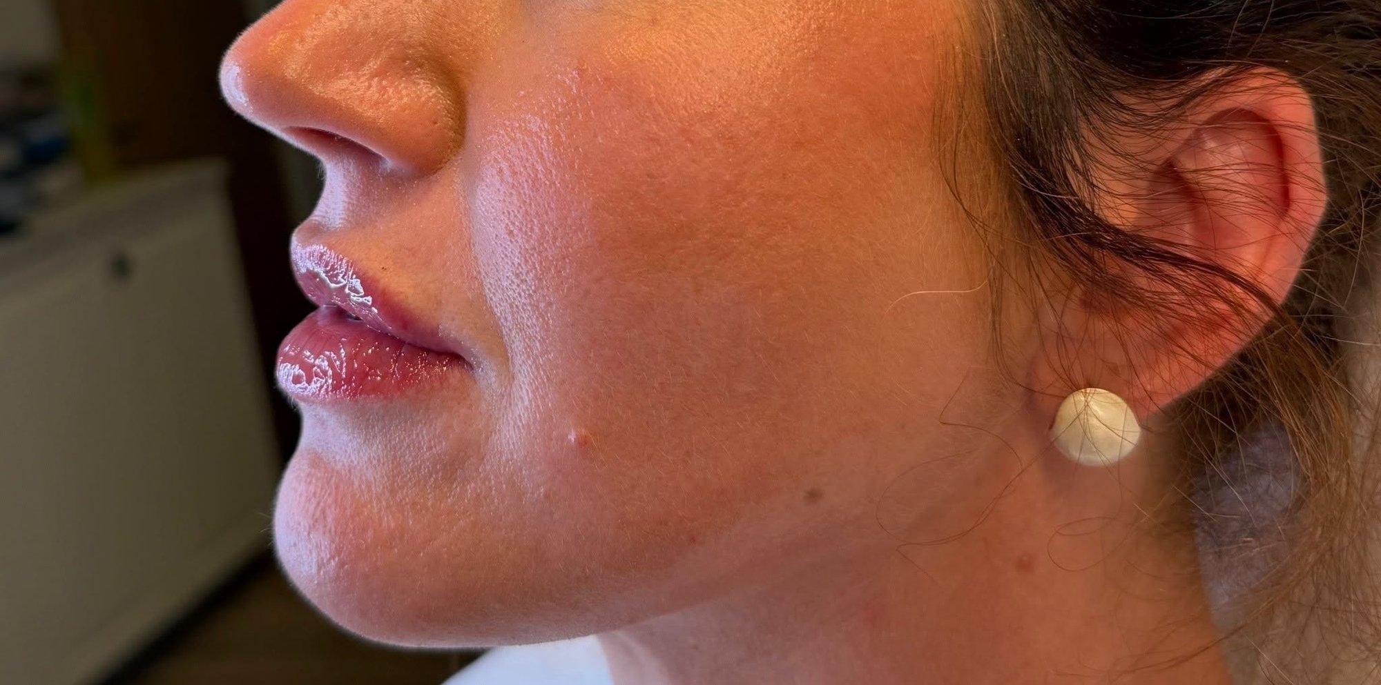 Lip filler — after