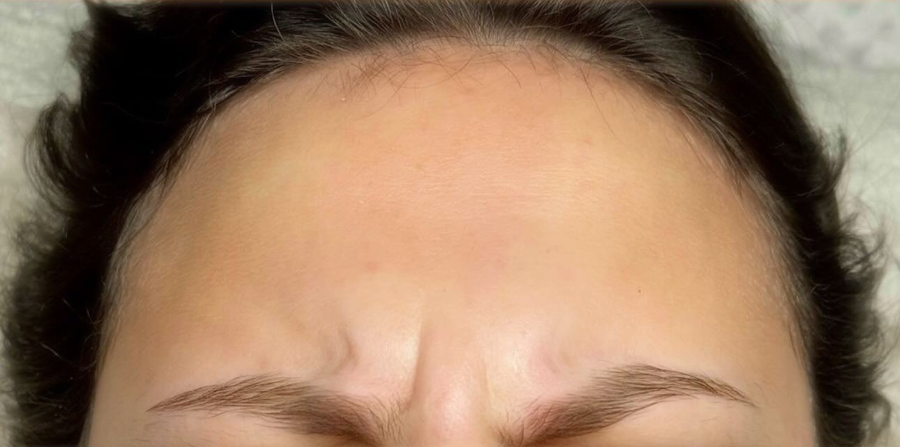Brow &amp; Eye Area — before