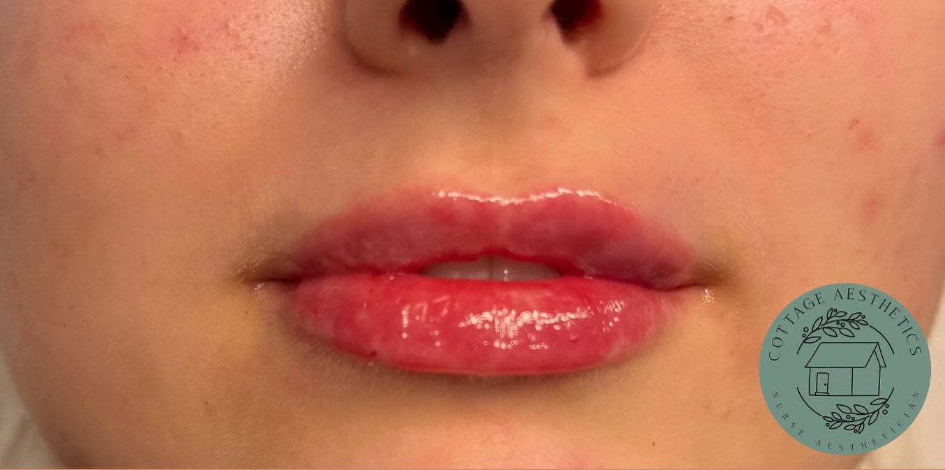 Lip Enhancement — after