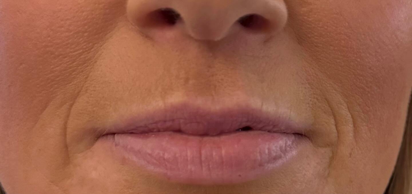 Lip Definition — before