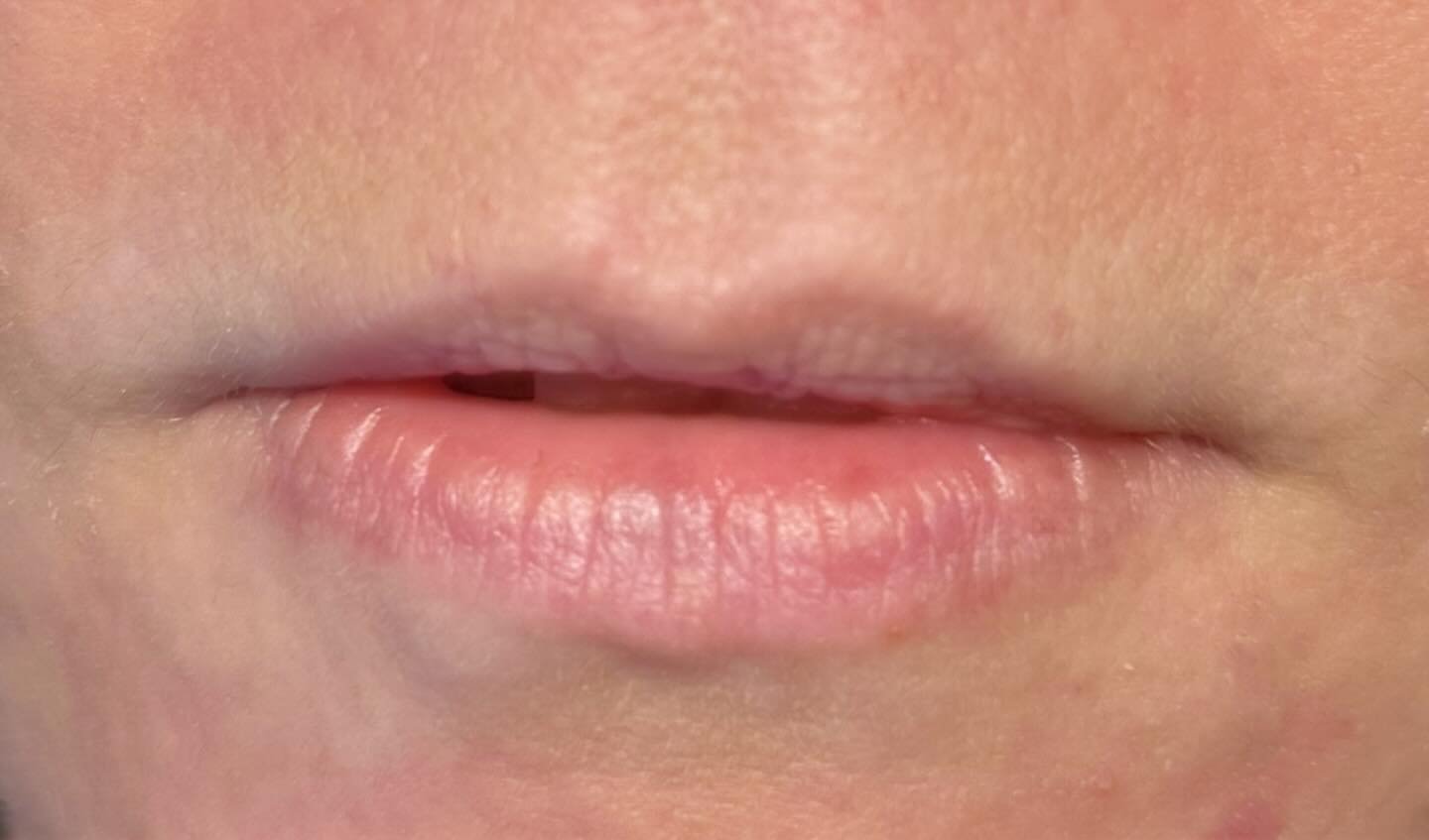 Lip Augmentation — before