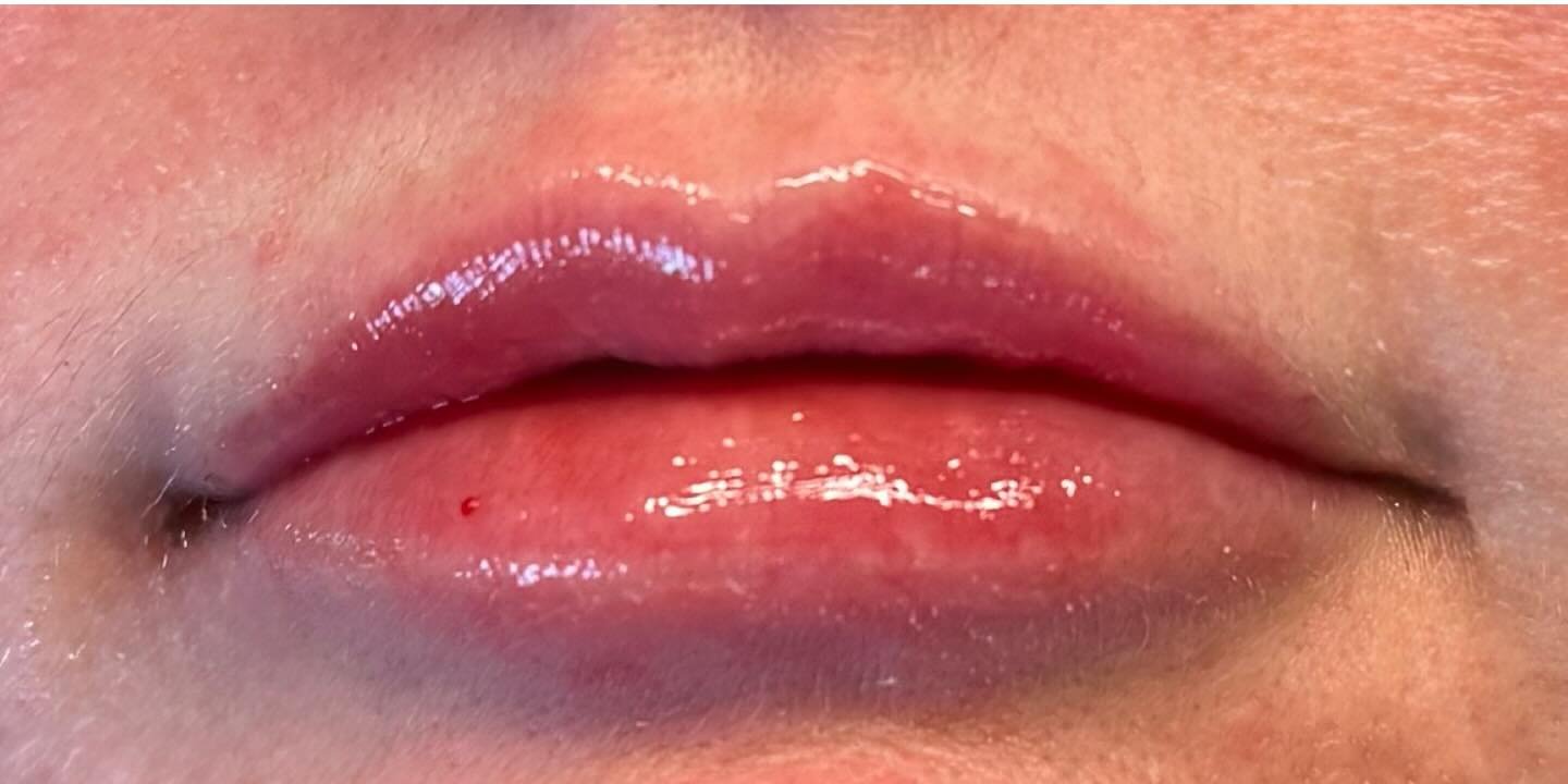 Lip Filler — after