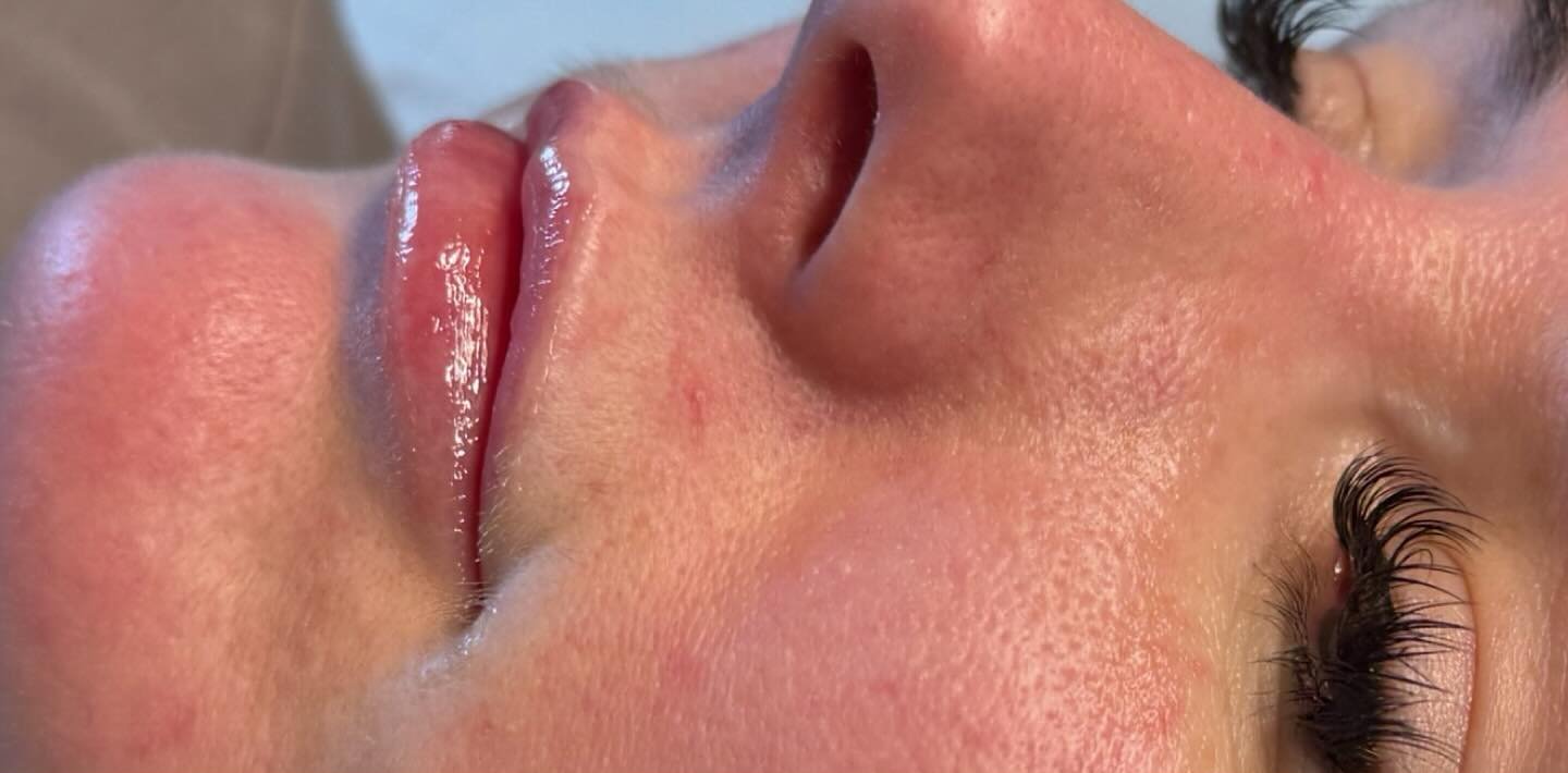 Lip Filler — before