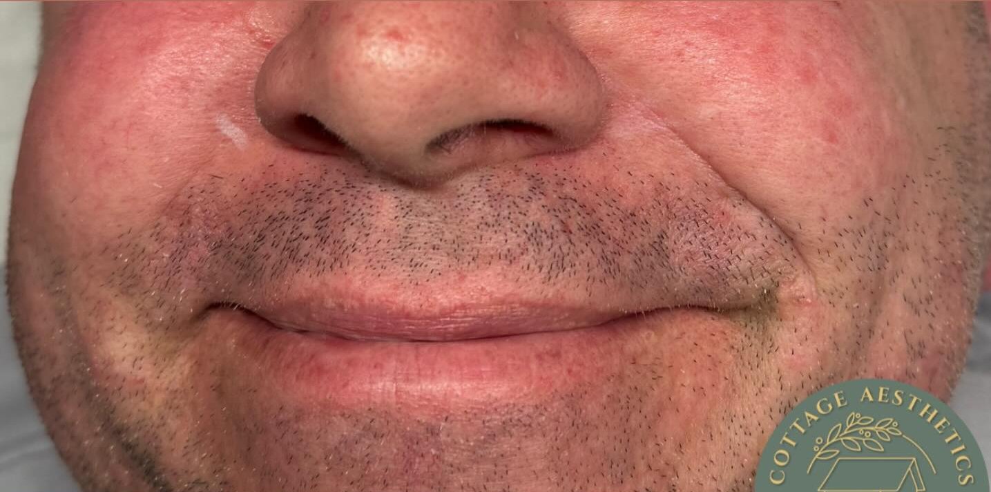 Cheek Filler — before