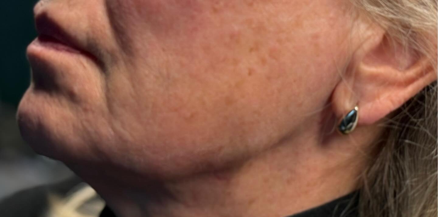 Jawline Definition — before