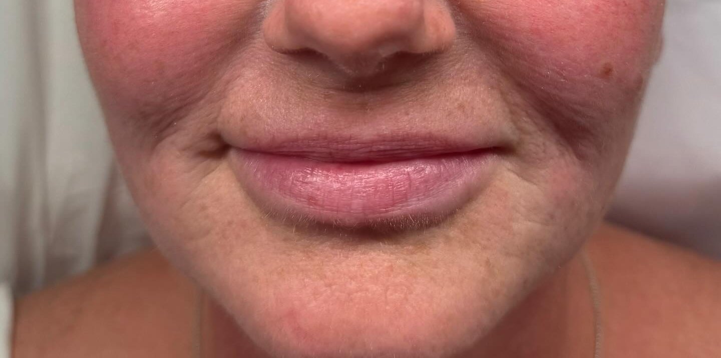 Jawline &amp; Skin — after
