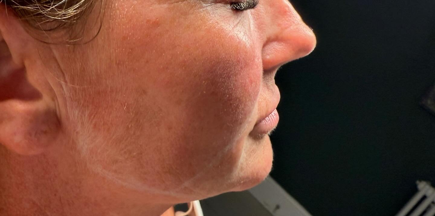 Chin Filler — before