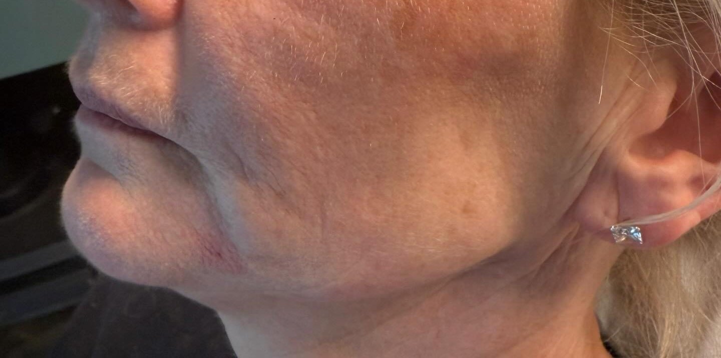 Jawline Contour — after