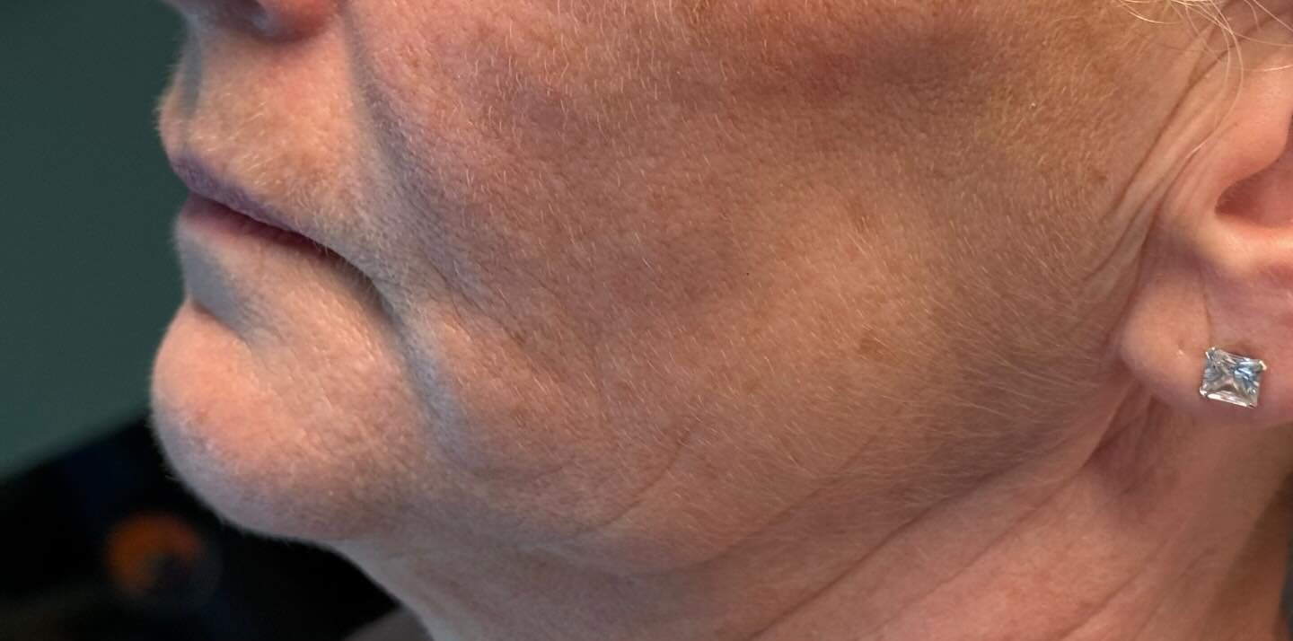 Jawline Contour — before