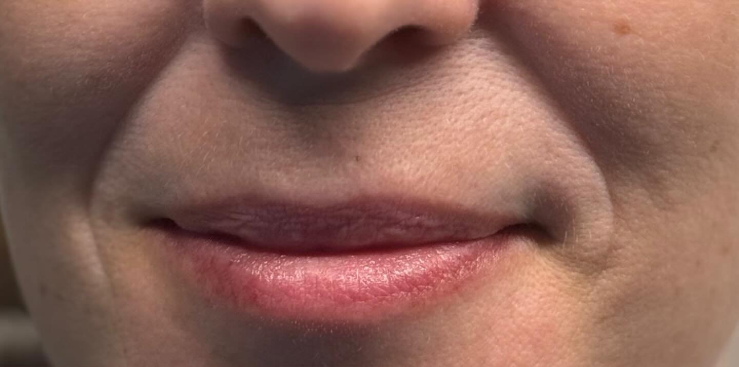 Cheek Filler — before