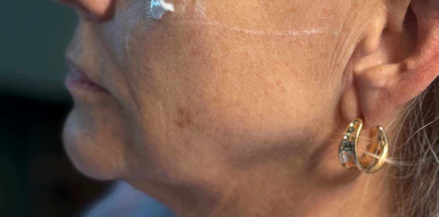 Jawline Definition — before