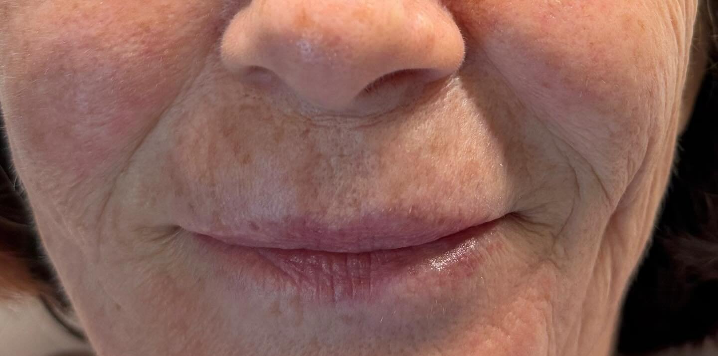 Nasolabial Folds — before