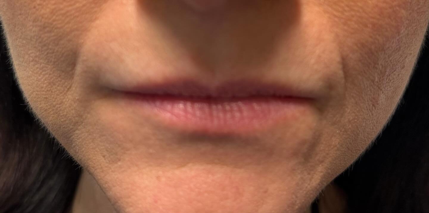 Lip Enhancement — before