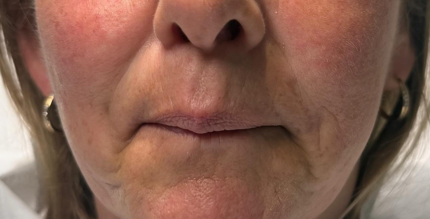 Cheek Contour — before