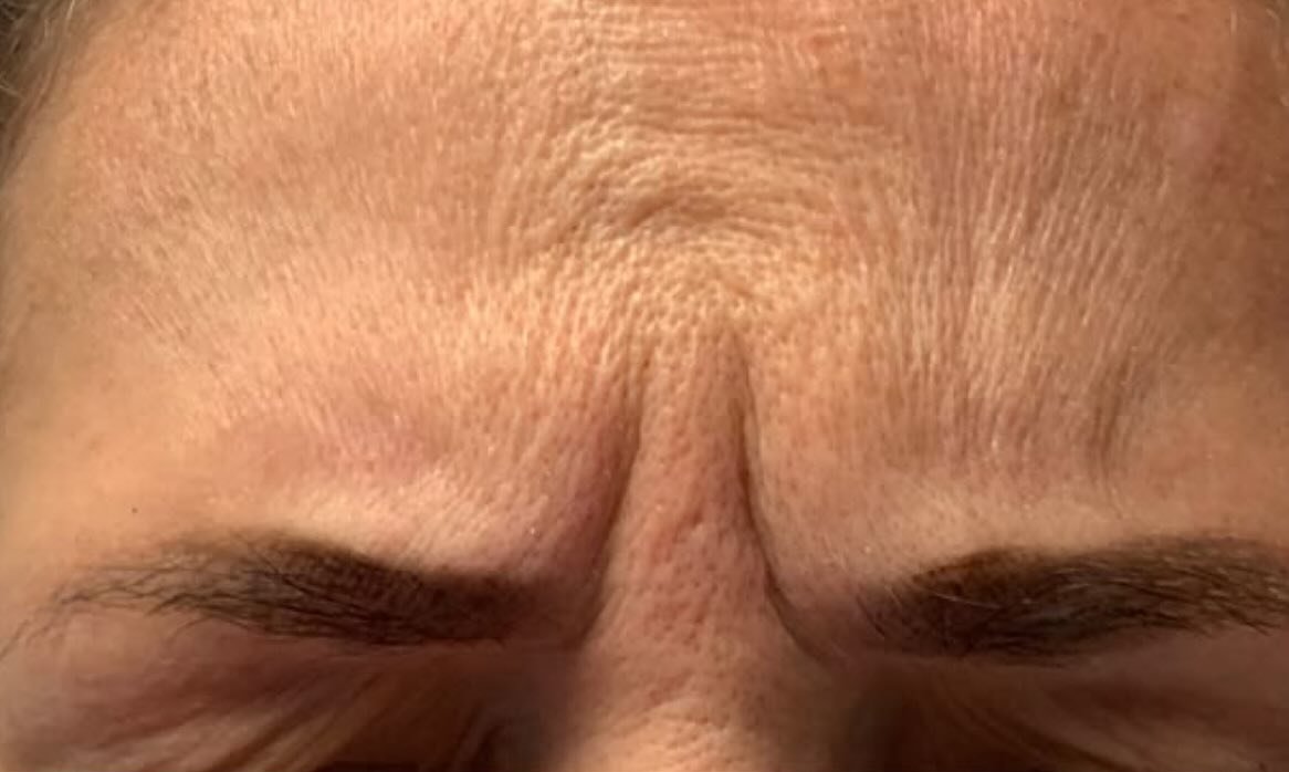 Under-Eye Rejuvenation — before