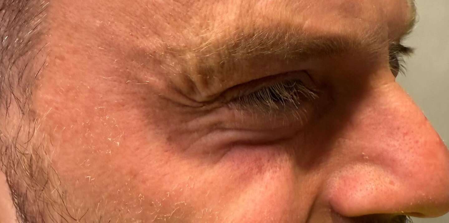 Brow &amp; Eye Area — after