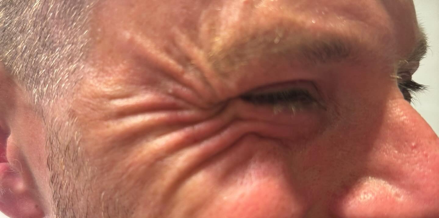 Brow &amp; Eye Area — before